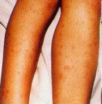 Men c leg rash